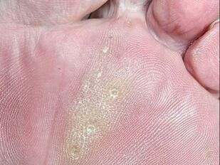 Kleine gelbe Samenkörner, die überall auf der Fußsohle eines Mannes verstreut sind.